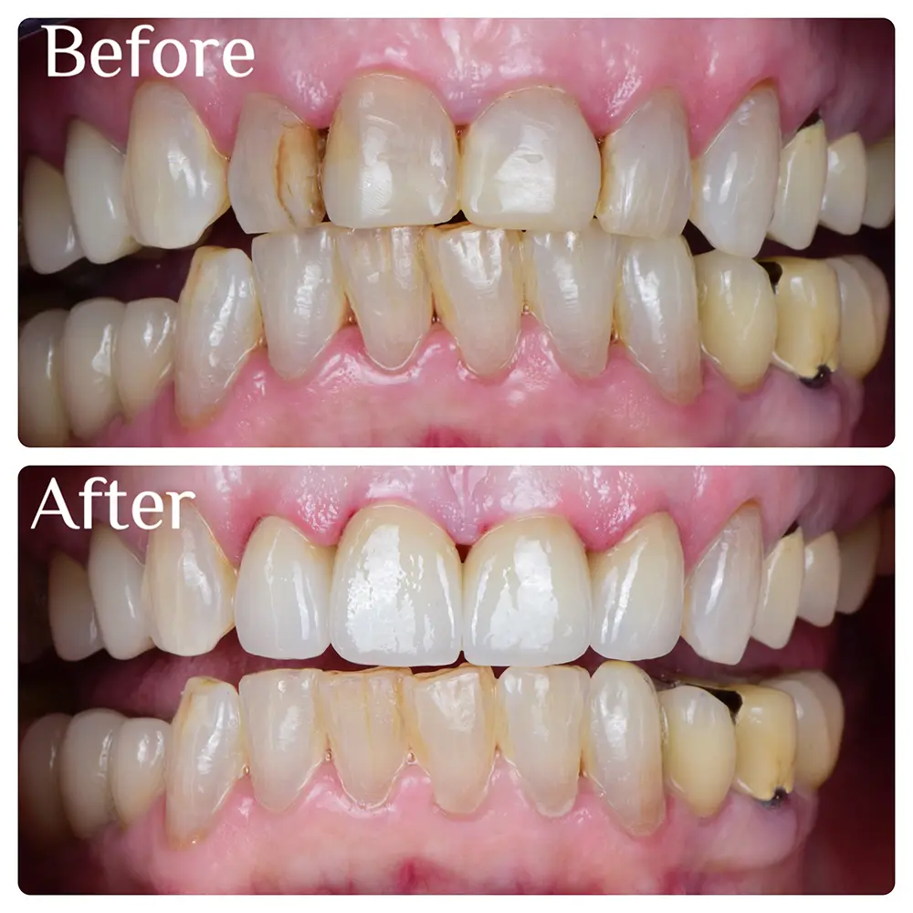 Before & After Veneers