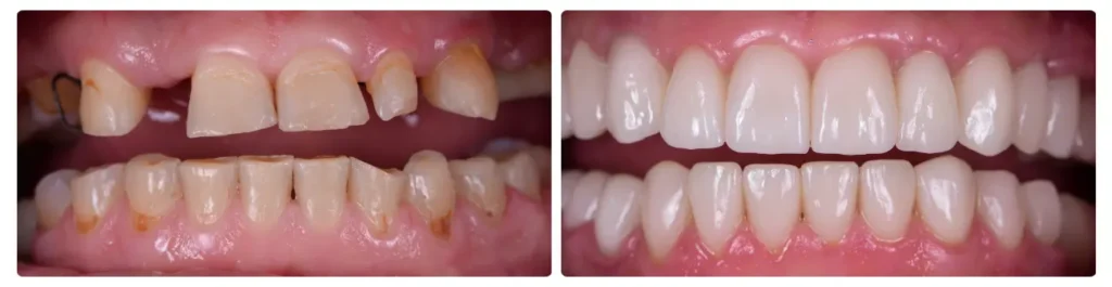 Dental Implants Before & After