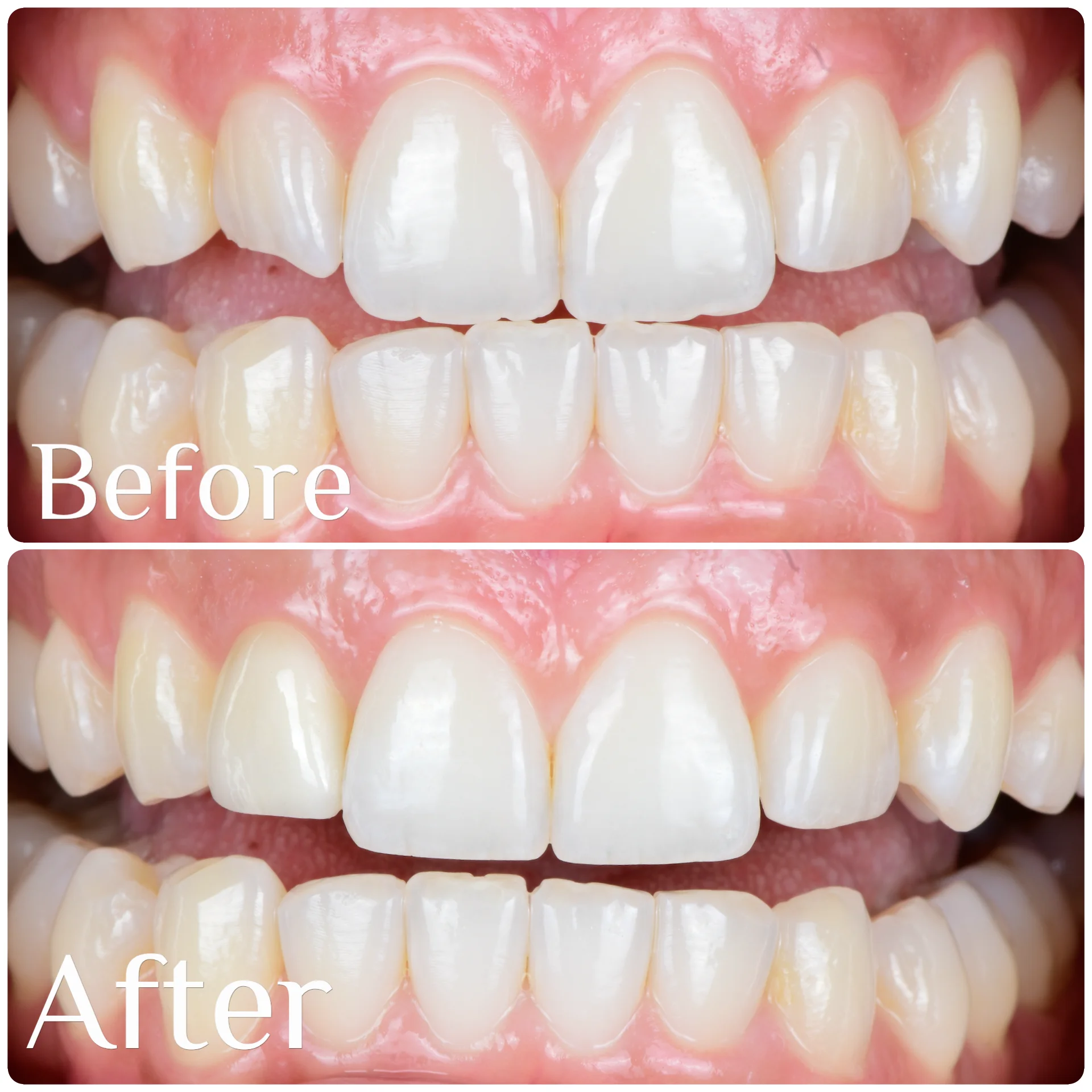 Before & After Smile Makeover With Dental Veneers